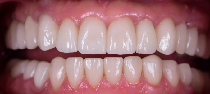 full mought recovery by press ceramic crowns and implants