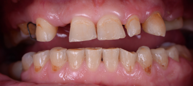 full mought recovery by press ceramic crowns and implants