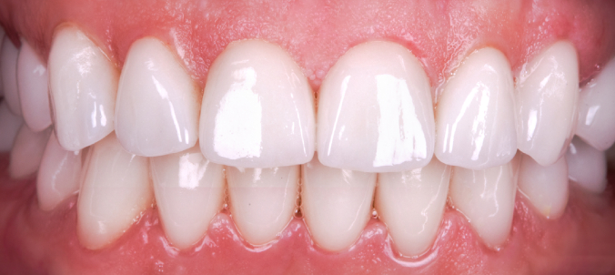 full mought recovery by press ceramic crowns and implants