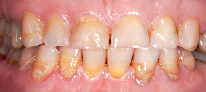 full mought recovery by press ceramic crowns and implants