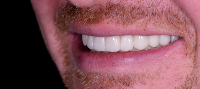 full mought recovery by press ceramic crowns and implants