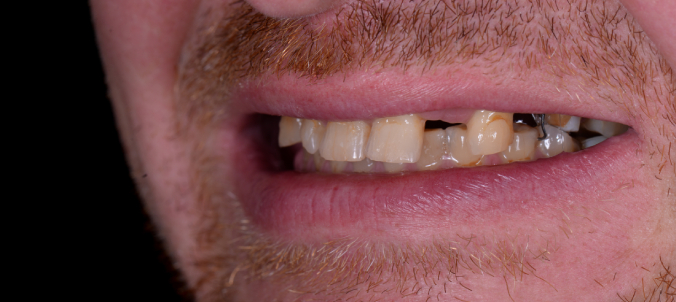 full mought recovery by press ceramic crowns and implants