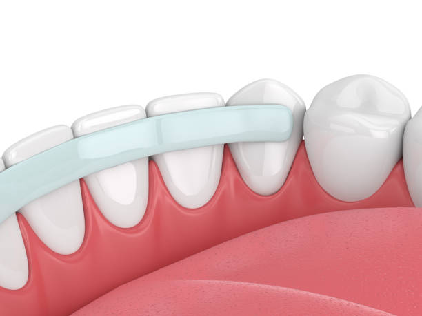 dental bonding near you