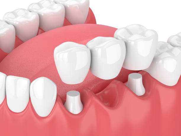 dental bridges near you