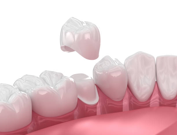 dental crowns near you