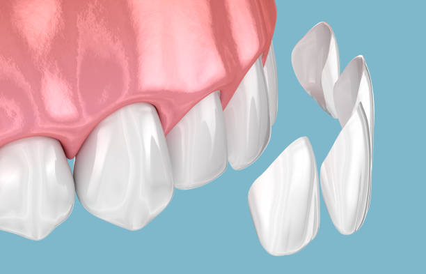 dental veneers near you