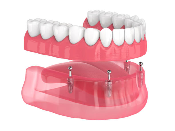 dentures near you