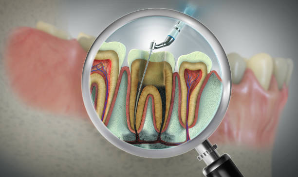 root canal therapy near you